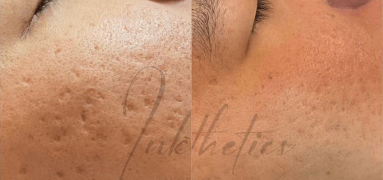 LP-Transformation-01-Acne Scars Treatment