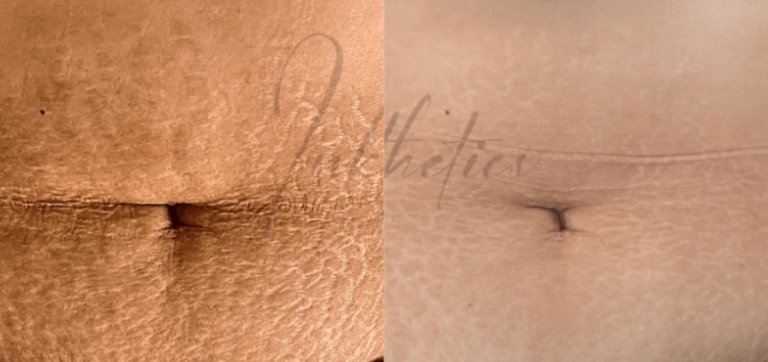 LP-Transformation-02-Stretch Mark Removal