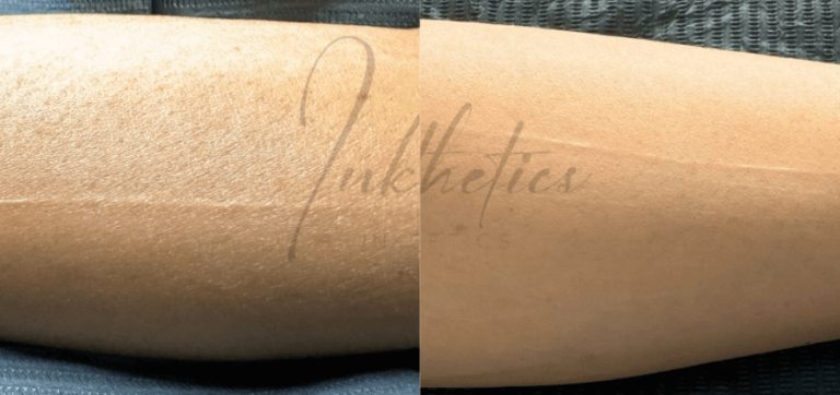 LP-Transformation-03-Surgical Scar Removal