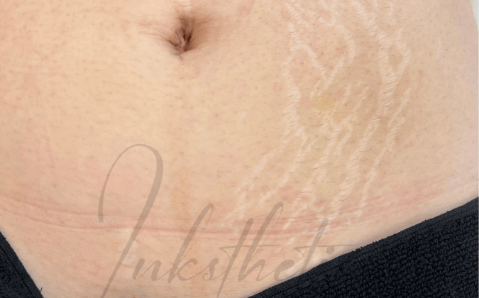 img-01-before-Stretch Marks