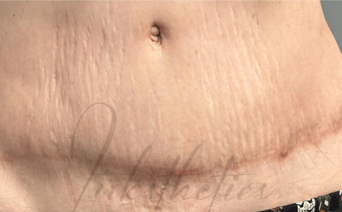 img-01-before-Surgical Scars