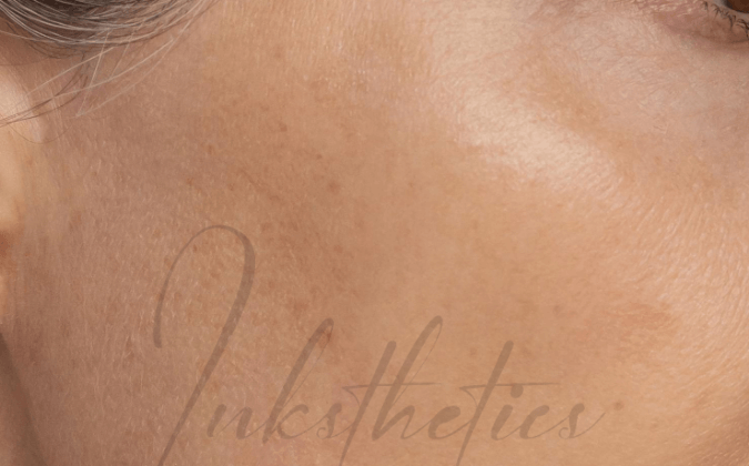 img-02-after-Hyperpigmentation
