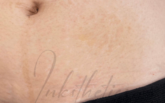 img-02-after-Stretch Marks