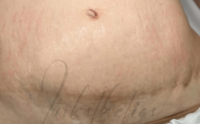 img-02-after-Surgical Scars