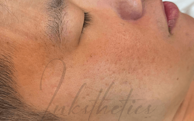 img-after-Acne Scars