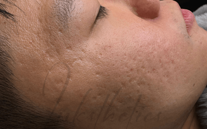 img-before-Acne Scars